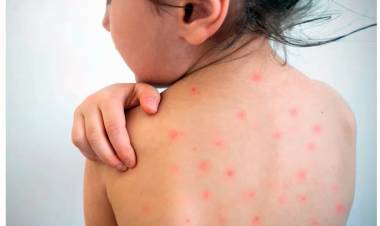 LOS CASOS DE SARAMPIÓN CRECEN EN EL PAÍS POR FALTA DE VACUNACIÓN